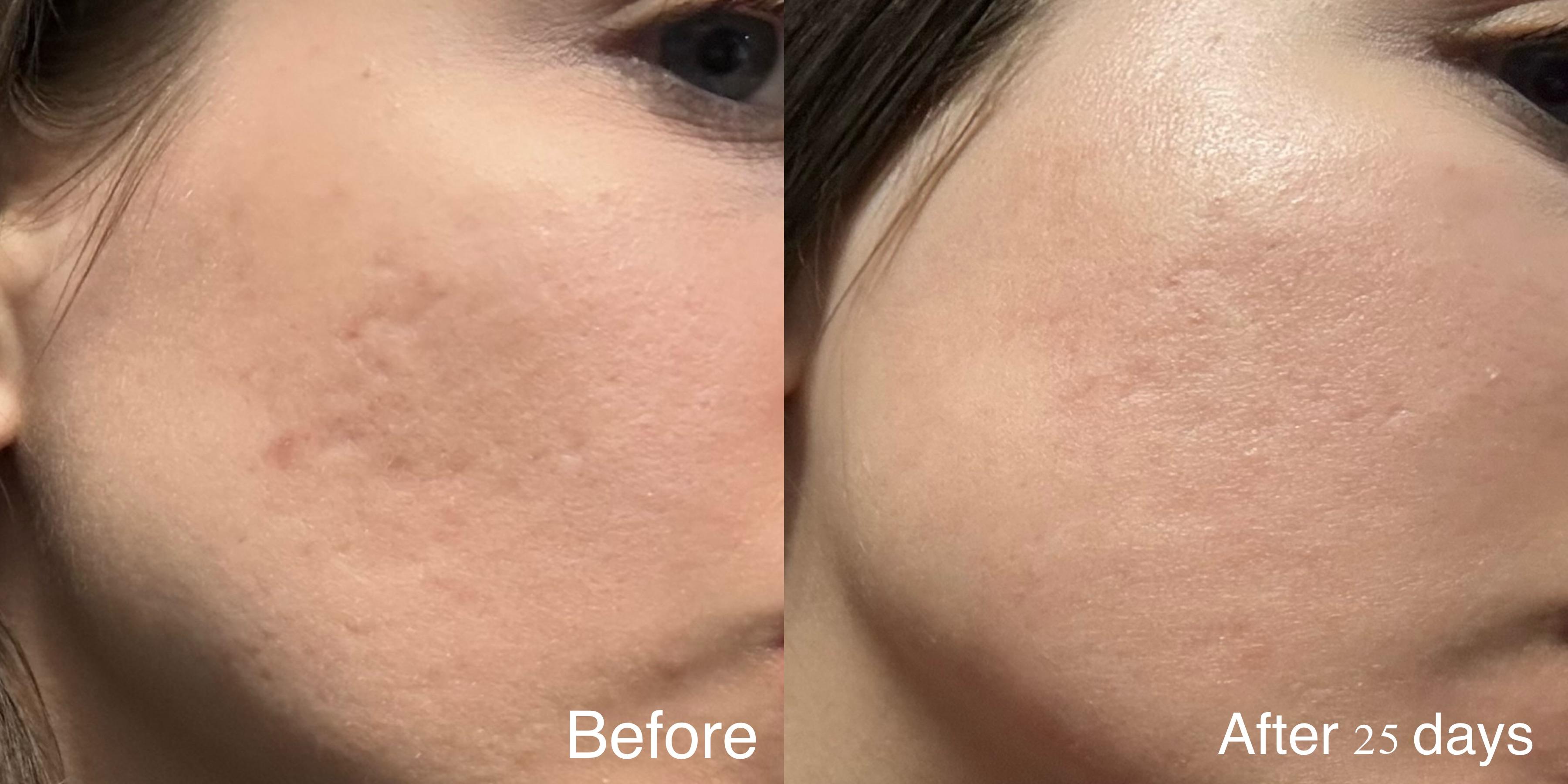 CO2 Fractional Laser (Per Session)