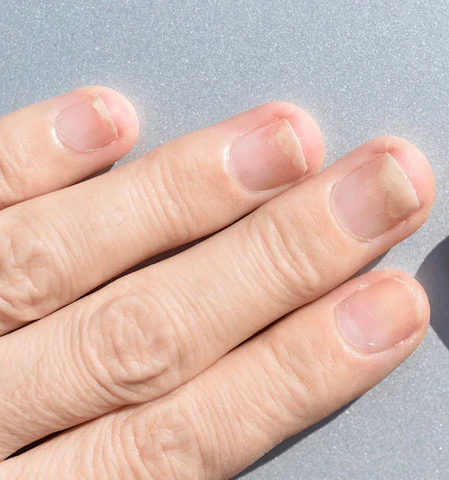 Nail Surgery (Single nail) No Discount