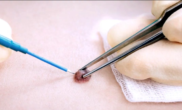 Electrocautery (Per session)